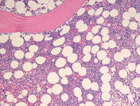Lymphocytic-variant-of-HES-Bone-marrow-biopsy