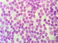 Chronic lymphocytic leukemia: Nuclei with ''Soccer ball chromatin''