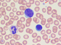 Neutrophil and Lymphocytes