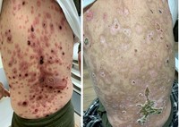 Total Skin Electron Therapy and Cutaneous T-Cell Lymphoma