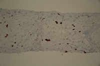 Immunohistochemical staining positive for the platelet marker, CD 61