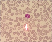 Bilobed lymphocytes 1