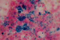 Iron-laden Macrophages in Anemia of Chronic Disease