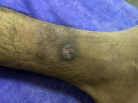 Leg ulcer complication in sickle cell patient. 2