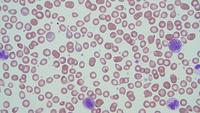 Myelofibrosis