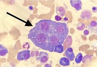 Multinucleated Plasma cell