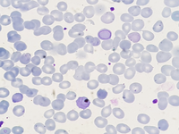 Cabot rings in a patient with Myelofibrosis