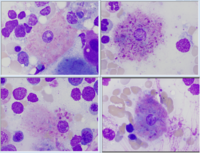 AUER RODS IN HISTIOCYTES AFTER TREATMENT OF ACUTE PROMYELOCYTIC LEUKEMIA.