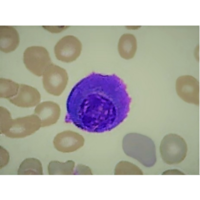Flame Cells in Plasma Cell Leukemia