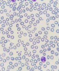 Stomatocytes and COVID-19