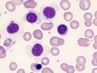 Hairy Cell Leukemia