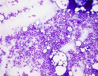Bone-marrow-aspirate-smear
