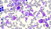 Systemic mastocytosis- bone marrow aspirate