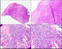 Myeloid Sarcoma