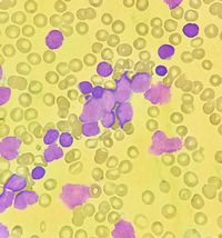 Precursor T-cell ALL