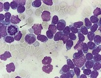 B-Cell acute lymphoblastic leukemia