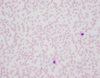Lymphoplasmacytic lymphoma
