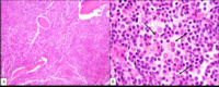 Lymphoplasmacytic-lymphoma--Bone-core-biopsy