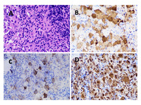 Langerhans cell histiocytosis