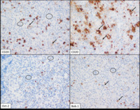 Classical-Hodgkin-lymphoma--IHC-2