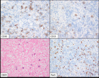Classical-Hodgkin-lymphoma--IHC