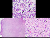 Classical-Hodgkin-lymphoma--HE