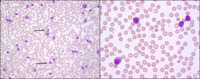 Chronic lymphocytic leukemia with atypical features