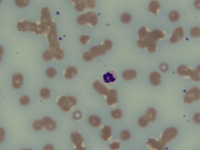 Bluish background staining in multiple myeloma peripheral blood film 1