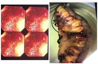 Von Willebrand disease with intestinal angiodysplasia