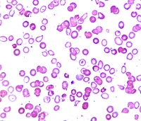 Homozygous HbE Disease in an antenatal woman from East India