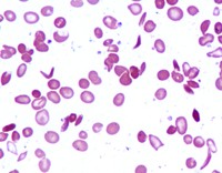 Double heterozygous HbSD Disease with sickling syndrome in a child