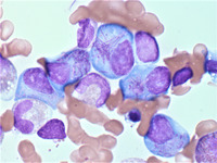 Pseudo-Auer rods in a myeloma patient 2