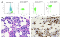 NK Cell Lymphoma/Leukemia with Strong p53 Expression