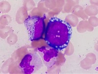proerythroblast showing prominent cytoplasmic vacuolation