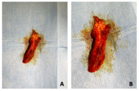 Severe acute gastrointestinal GVHD in patients undergoing HSCT: an open challenge
