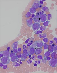 Bone-Marrow-Aspirate-at-high-power