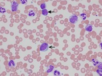 Peripheral-blood-smear