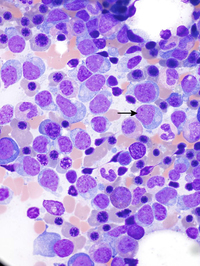 Marrow-aspirate-at-High-power