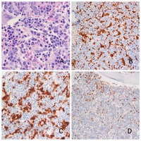 Hepatosplenic T-cell lymphoma