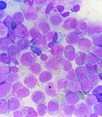 Faggot cells in Acute Promyelocytic Leukemia