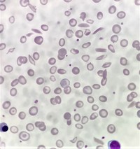 Sickle cell anemia