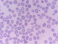 Cabot Rings in Severe Cobalamin Deficiency (Vitamin B12)