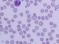 Leishman stain 100 X; Bite cells, Blister cells and toxic granulation in neutrophil