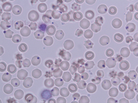 100X Heinz bodies in wet film preparation