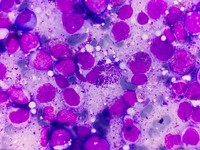 Bone marrow imprint smear showing blasts and eosinophilia