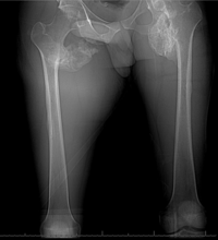 CT Rt Femur: Fig 1- Scout Image, Fig 2- cross section, Fig 3- coronal plane, Fig 4- sagittal plane 1