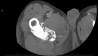 CT Rt Femur: Fig 1- Scout Image, Fig 2- cross section, Fig 3- coronal plane, Fig 4- sagittal plane 2
