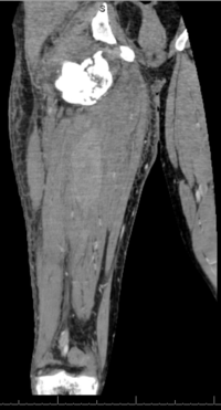 CT Rt Femur: Fig 1- Scout Image, Fig 2- cross section, Fig 3- coronal plane, Fig 4- sagittal plane 3