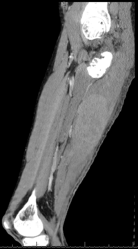 CT Rt Femur: Fig 1- Scout Image, Fig 2- cross section, Fig 3- coronal plane, Fig 4- sagittal plane 4