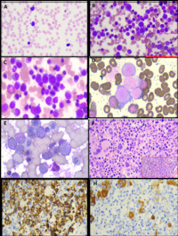Pure Erythroid Leukemia